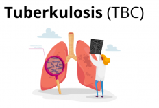 Penyakit TBC di Kota Cirebon Terus Melonjak, di Tahun 2023 Capai 4.164 Kasus